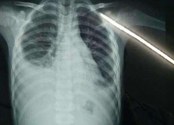 胸腔积液示意图