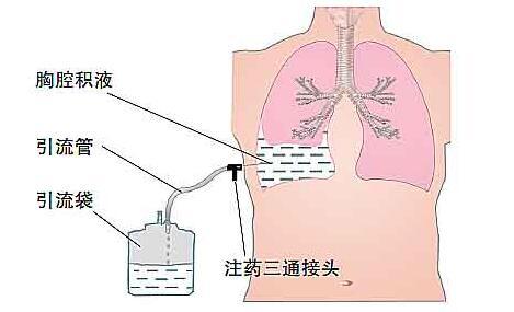 胸腔积液的原因