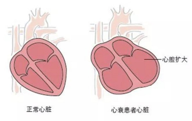 心功能二级是不是心衰