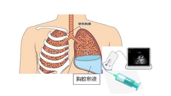 胸腔少量积液会自愈吗