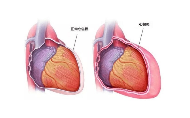 心包积液癌症几率大吗