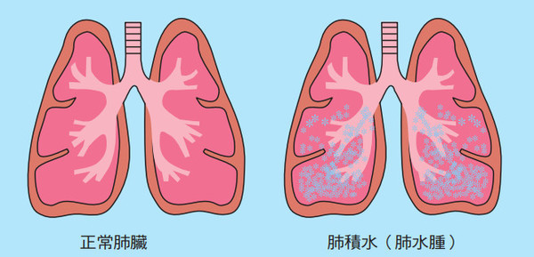肺部积液抽出来是血水严重吗