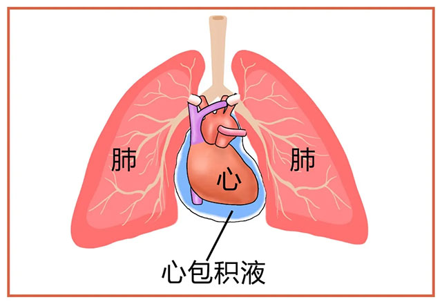 治老人心包有积液