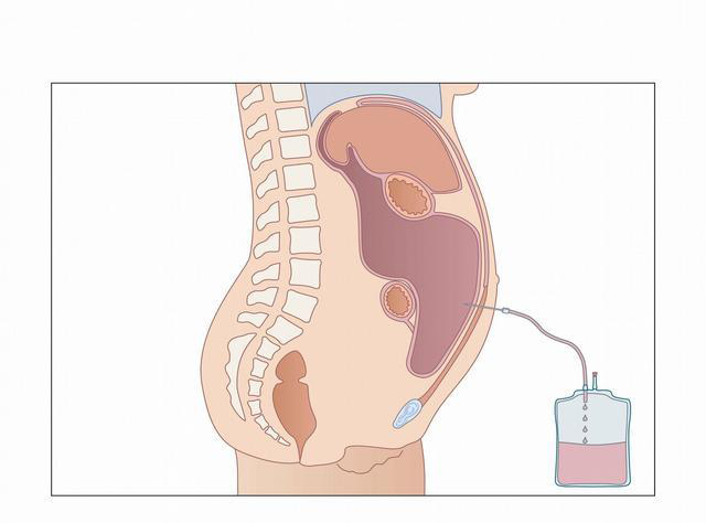 腹腔肠间积液怎么回事